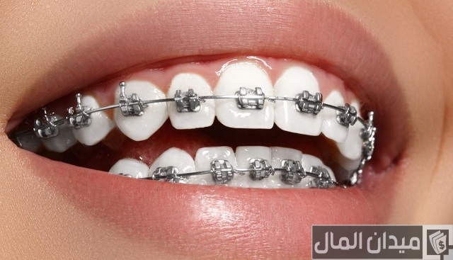 كم سعر تقويم الاسنان في السعودية كم سعر تقويم الاسنان في السعودية