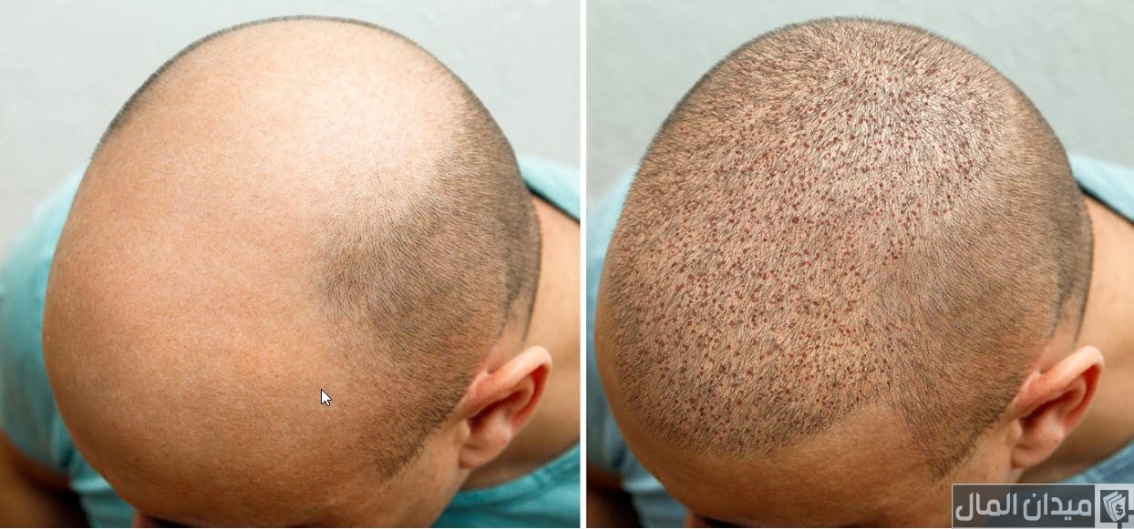 كم تكلفة زراعة الشعر في تركيا بالدولار