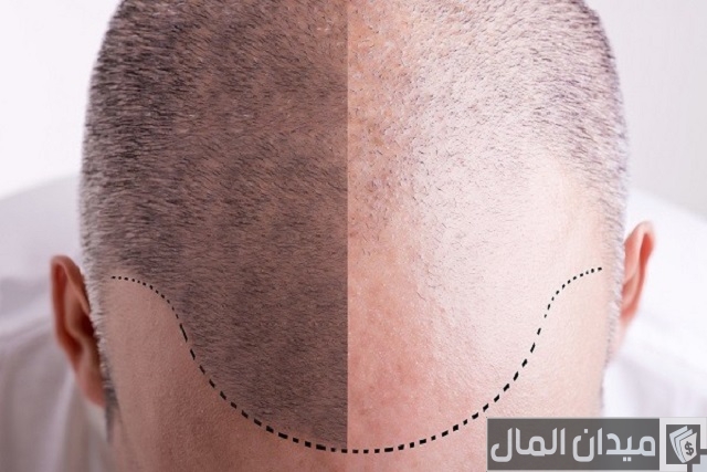 تكلفة زراعة الشعر في تركيا