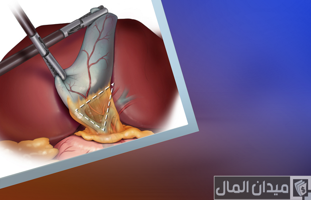تكلفة عملية المرارة في السعودي الألماني